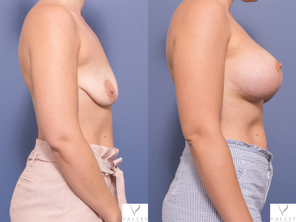 Breast Implants BA 03 (in combination with Breast Reduction and Breast Lift)