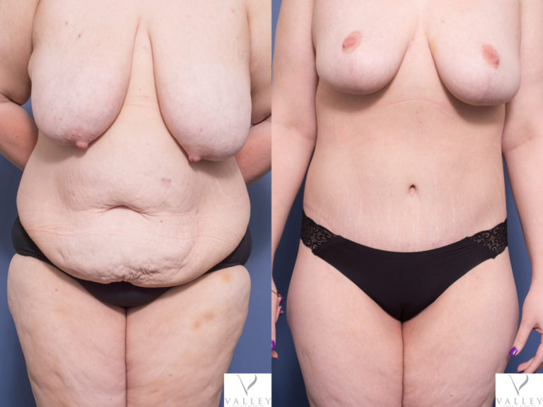 Tummy tuck before & after 1A - Belt Lipectomy, Bilateral Breast Reduction and Bilateral Brachioplasty