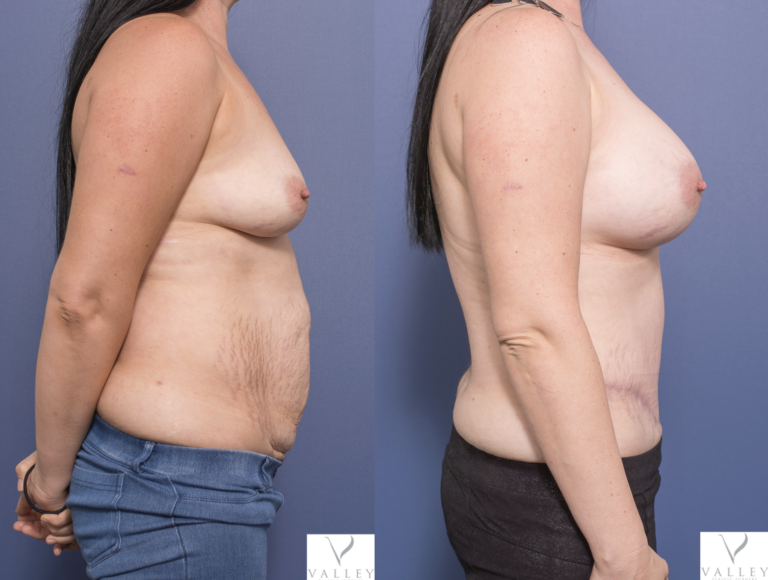 Dr Peters patient 8C, tummy tuck & breast augmentation, side view