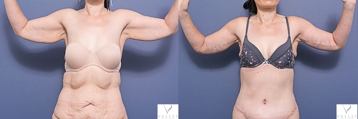 Bilateral Brachioplasty (Arm Lift) and Bely Lipectomy, before & afters 1B, Dr Matthew Peters