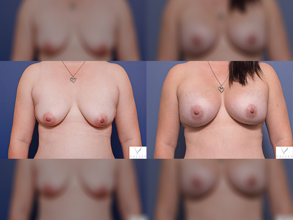 Breast Augmentation with breast implants 15A