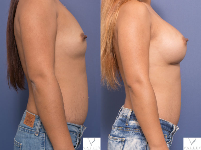 Dr Peters, Breast Implants 390cc, breast implants