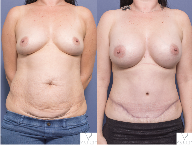 Patient's photo 3A before and after breast augmentation (and Tummy Tuck), Dr Peters