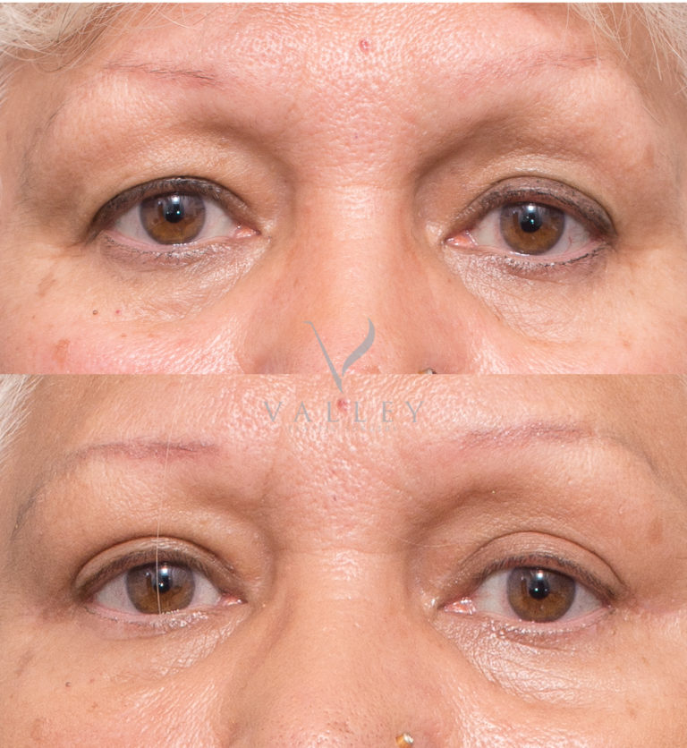 Upper eyelid reduction surgery (Blepharoplasty) before and after 1A, Dr Peters