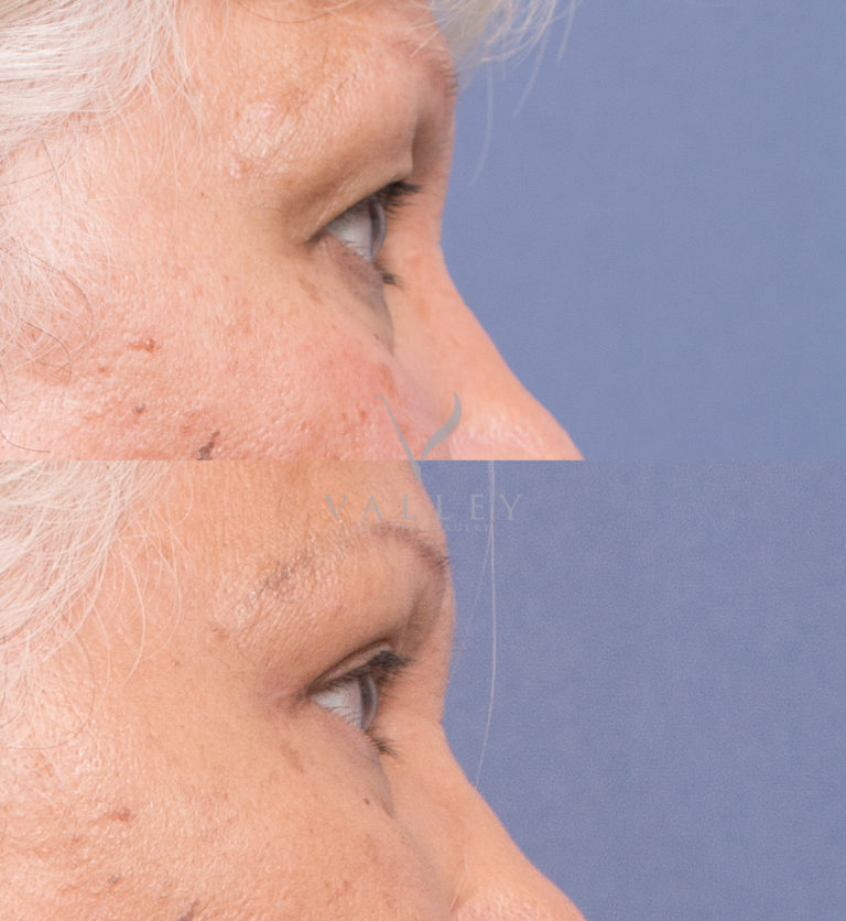Upper Blepharoplasty (eyelid reduction), before and after gallery, patient 1C