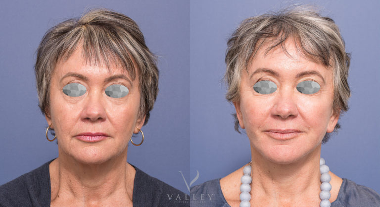 Facelift surgery patient before & after 01, Dr Peters Brisbane