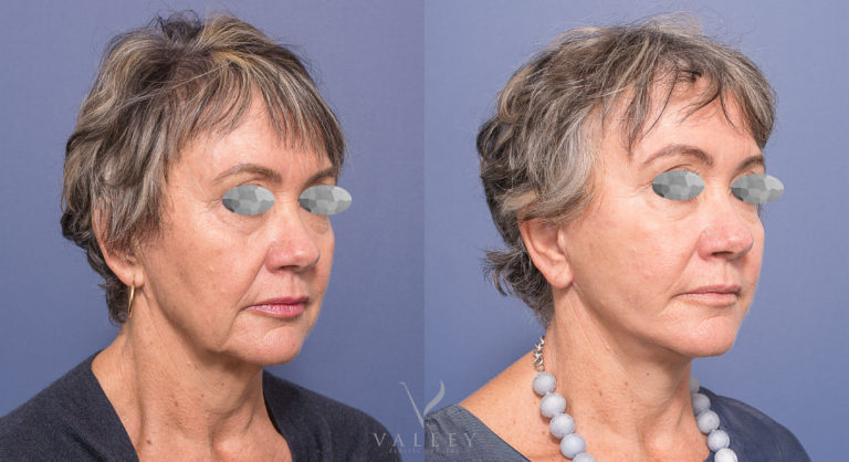 Dr Peters, oblique facelift 02, patient before and after