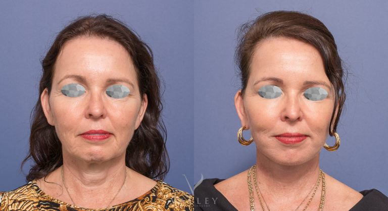 Facelift & neck lift patient before and after surgery 02-1, front view