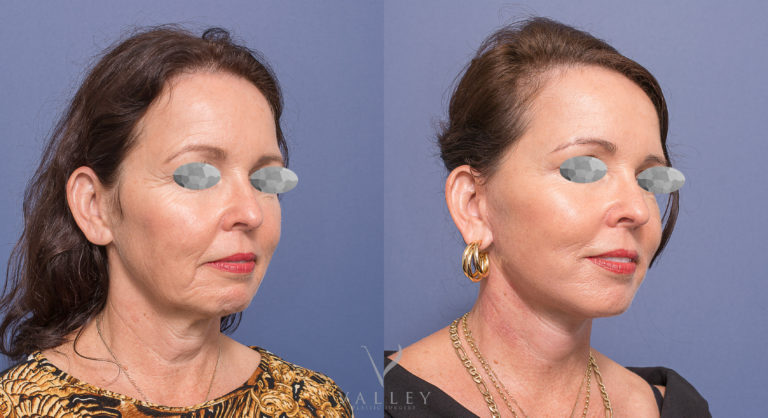 Face Lift & Neck Lift patient 02, before & afters, Dr Peters