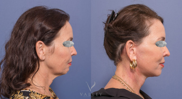 Facelift, Neck Lift and Blepharoplasty before & after 02-3, Dr Peters Brisbane QLD