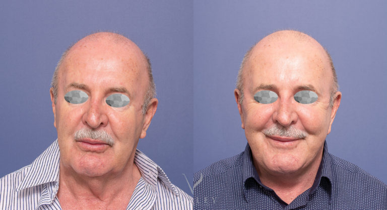 Male Facelift and Neck Lift 03, Dr Peters
