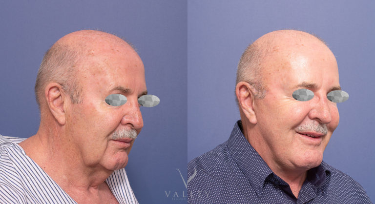Male Face and Neck Lift before & after 03-2