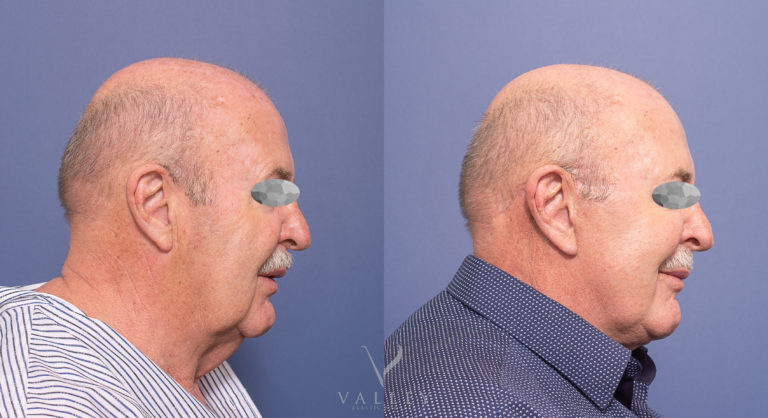 Facelift and Neck Lift 03-3, male patient, side view