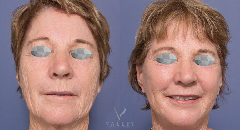 Patient 04 before & after Facelift & Neck Lift surgery with Dr Peters
