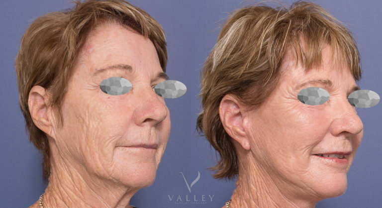 Face lift and neck lift, patient before & after surgery, photo 04-2