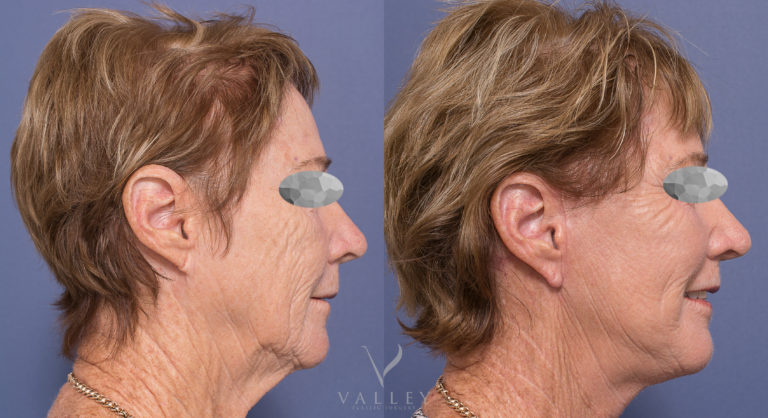 Patient 04-3 before & after facelift and neck lift surgery at Dr Peters clinic in Brisbane