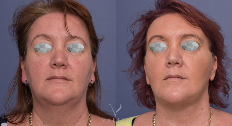 Face and Neck Lift before & after 05-1, front view, Dr Peters