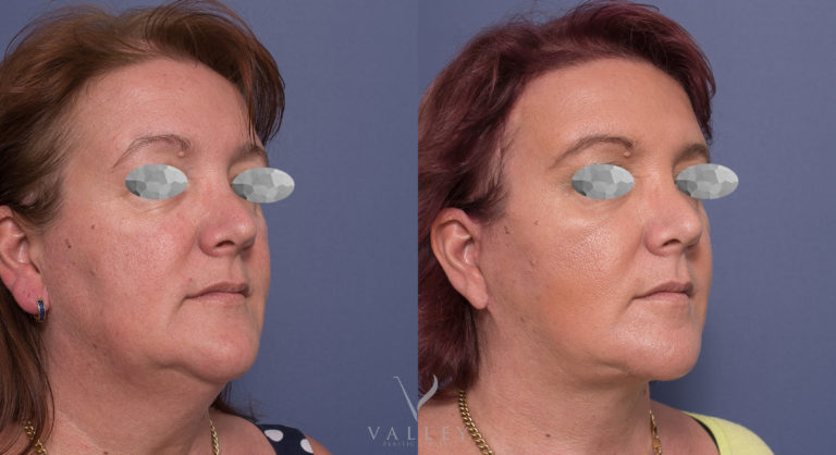 Facelift surgery with Dr Peters, before & after gallery 05-2, angle view