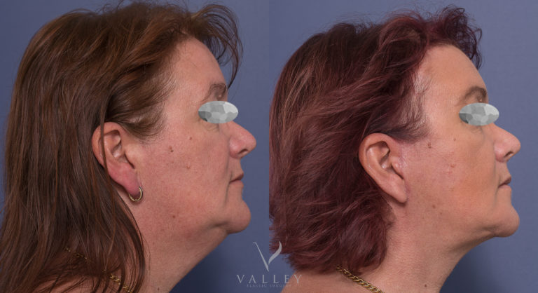 Face and Neck Lift 05-3, Dr Peters, Brisbane QLD