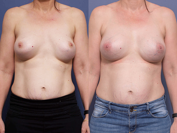 Breast Implant Revision Surgery before & after 1A, Dr Peters Brisbane