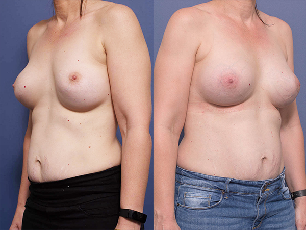 Breast Revision, before and after gallery 1B, Dr Peters