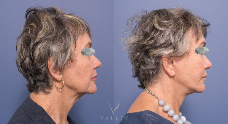 Dr Peters patient before & after facelift surgery 03, side view