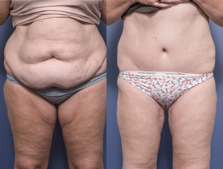 Belt Lipectomy and Medial Thigh Lift before & after 3A, Dr Peters