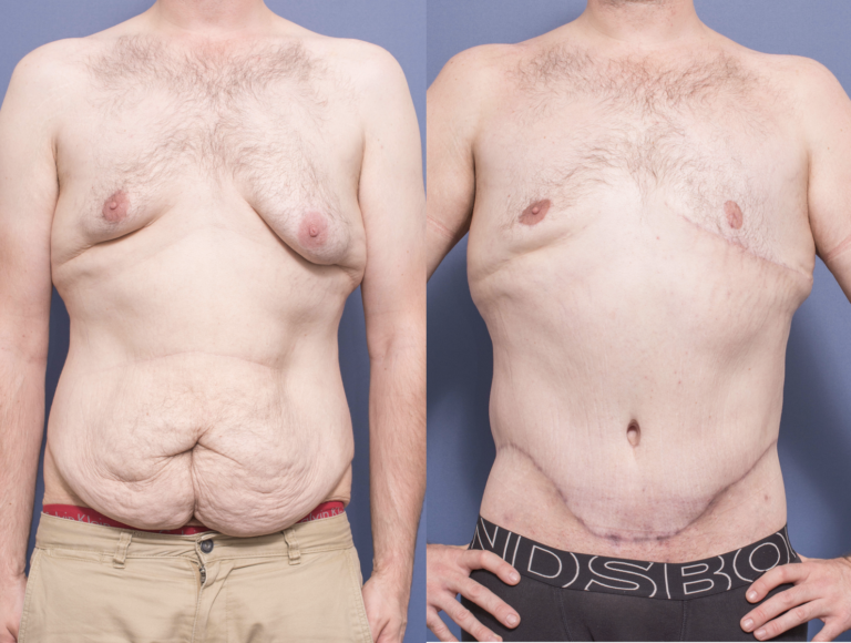 Male patient, Gynecomastia & Belt Lipectomy before and after 4A