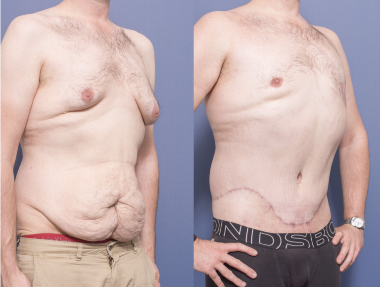 Male Breast Reduction & Belt Lipectomy before and after 4B