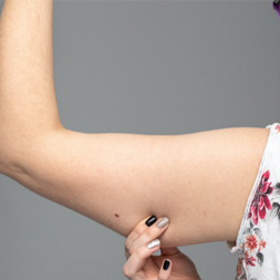 Brachioplasty (arm lift) model 02, Dr Matthew Peters Brisbane